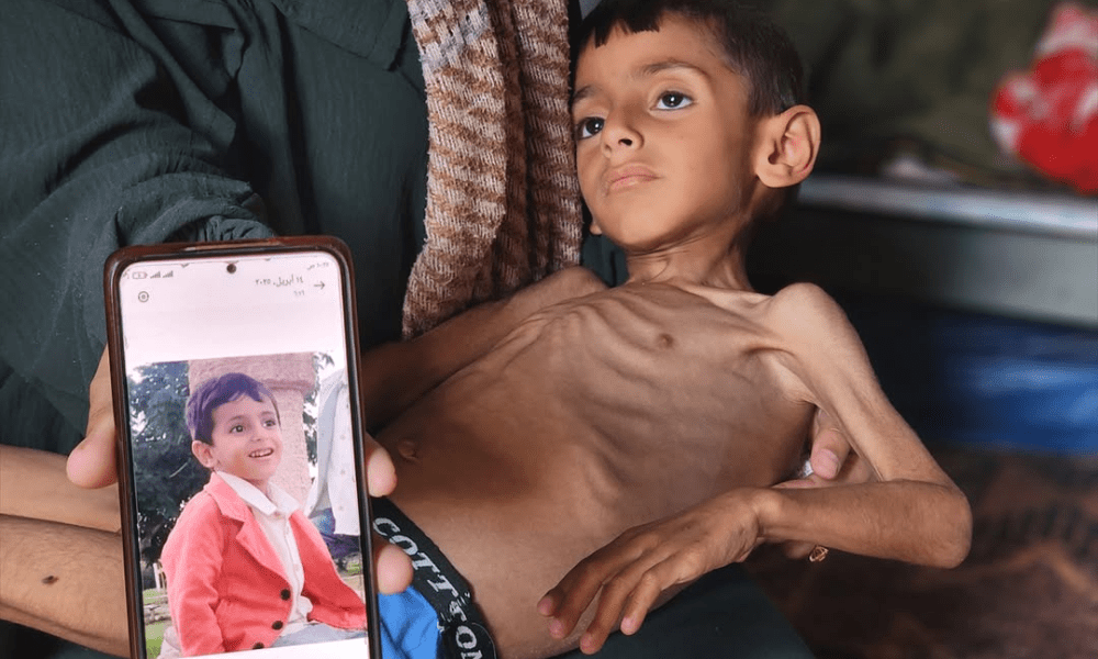 Desnutrição entre crianças em Gaza aumenta devido ao bloqueio israelense
