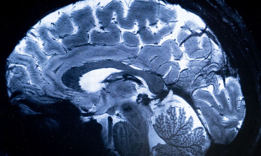 Reino Unido lança pesquisa para detectar Alzheimer de maneira precoce