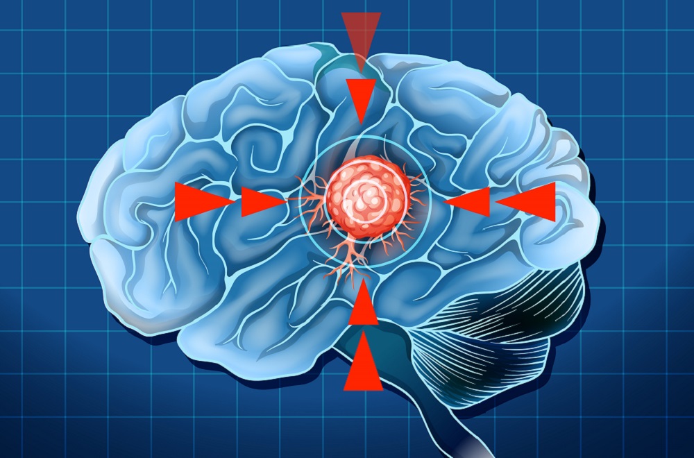 Glioblastoma: o tumor cerebral mais agressivo e o desafio da medicina moderna