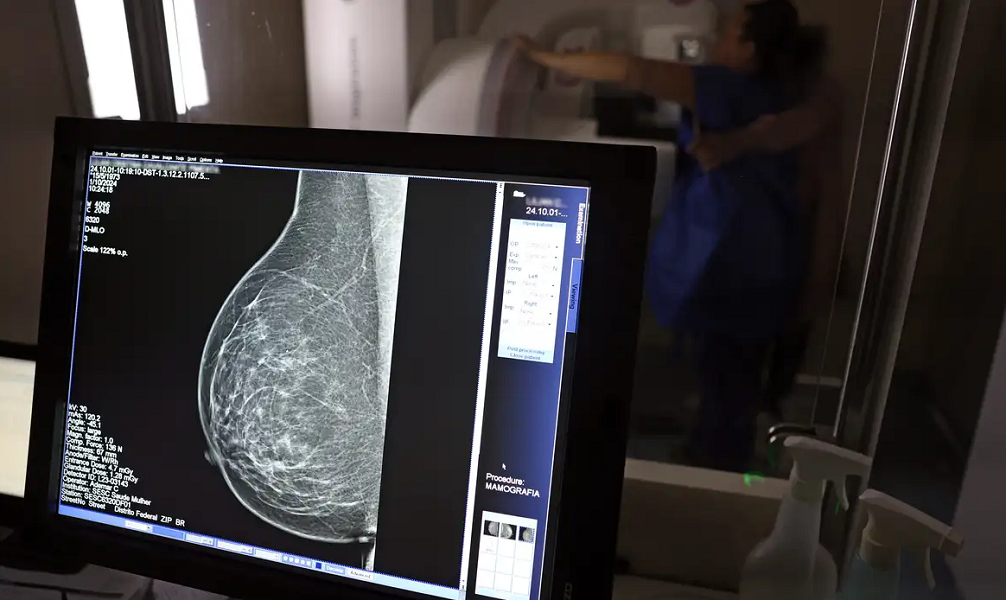 Ministério da Saúde passa a recomendar mamografia a partir dos 40 anos
