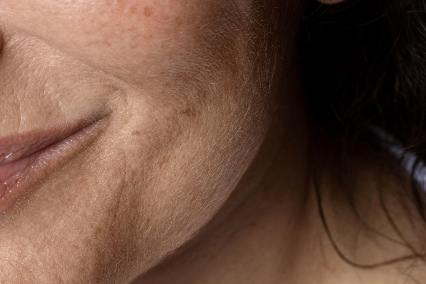 Melasma no inverno: tratar a mancha exige olhar além da pigmentação