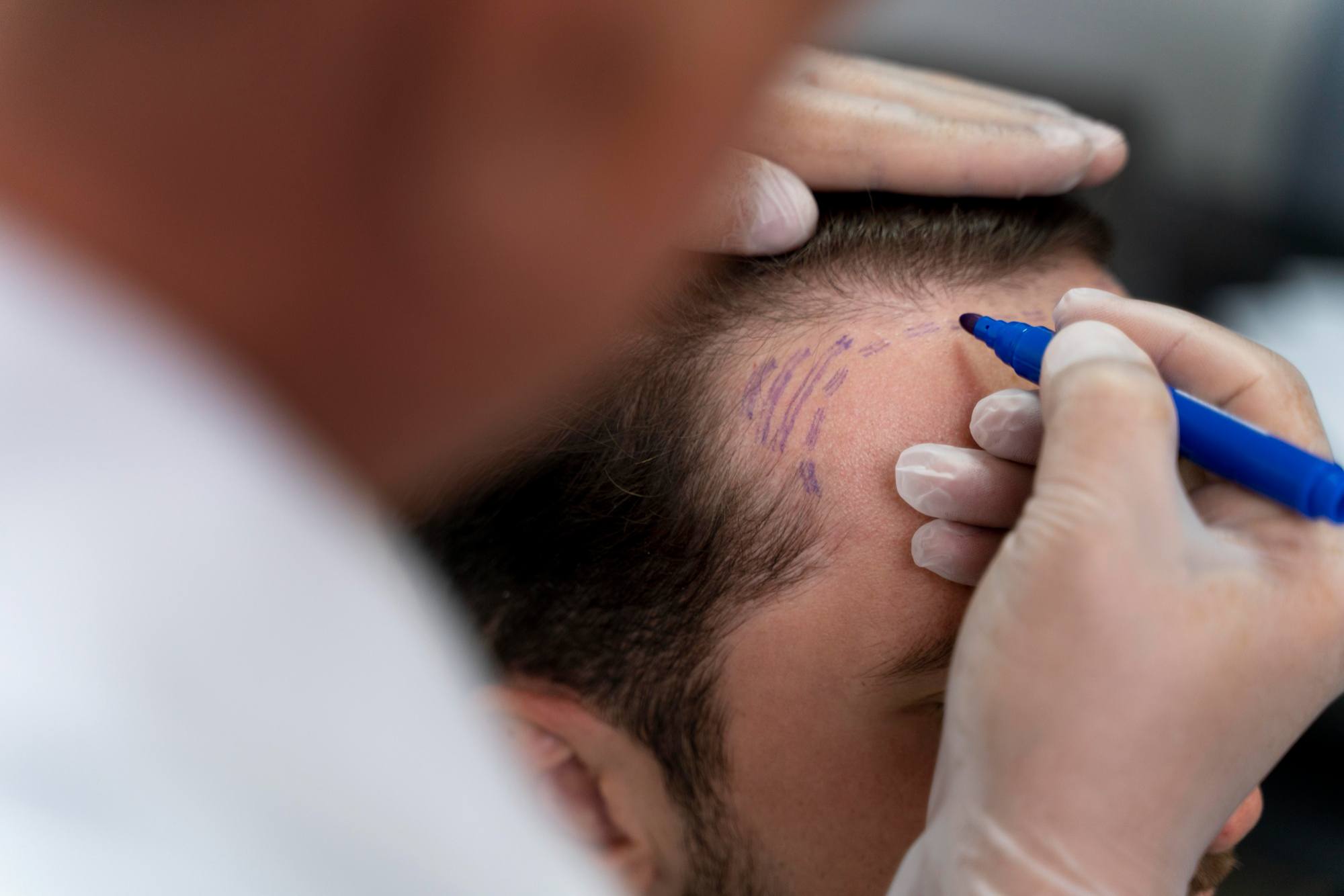 Transplante capilar evoluiu; risco agora é tratar uma cirurgia sofisticada como um procedimento simples