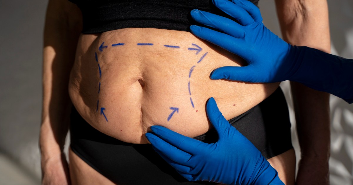 Lipoaspiração é segura? Entenda quais fatores realmente determinam o risco da cirurgia