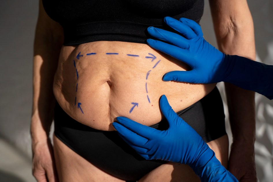 Lipoaspiração