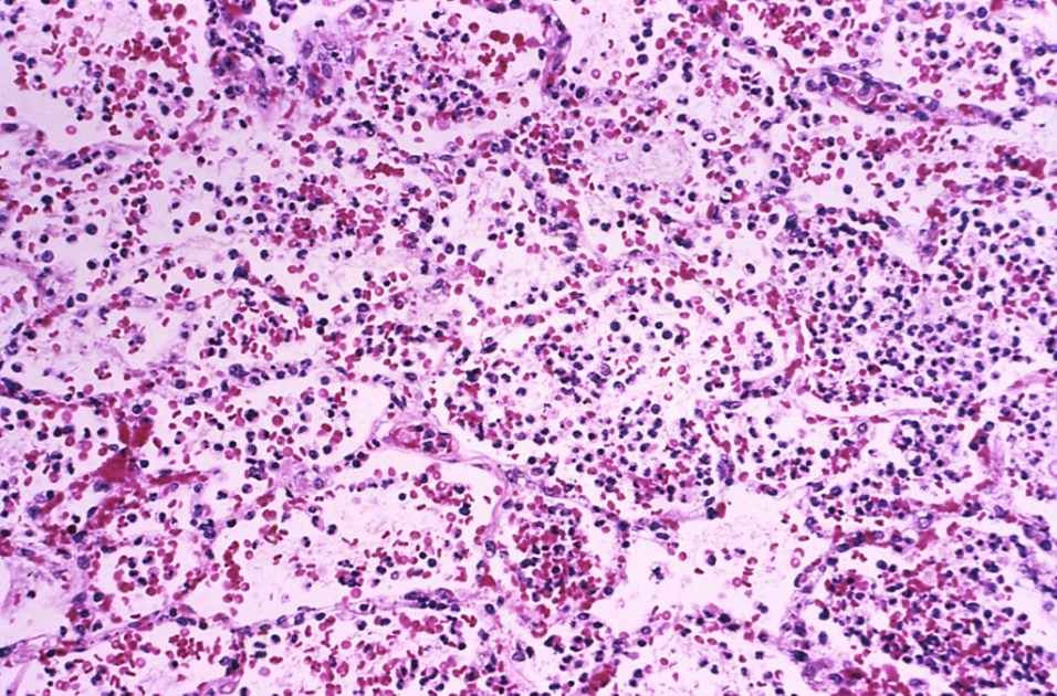 Tecido de pulmão que está infectado com a peste pneumônica