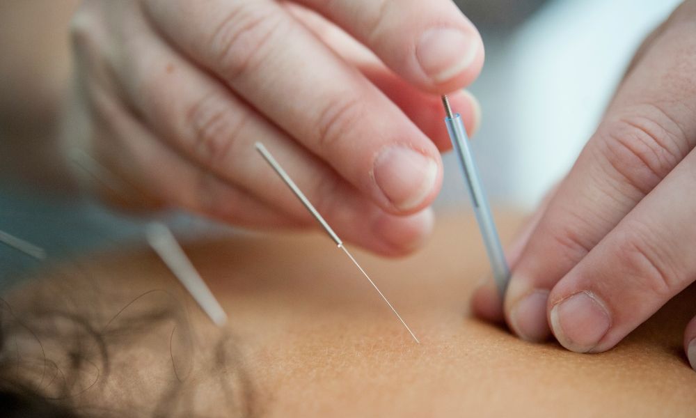 Acupuntura para insônia: ela ajuda mesmo a dormir melhor? Veja o que a ciência diz